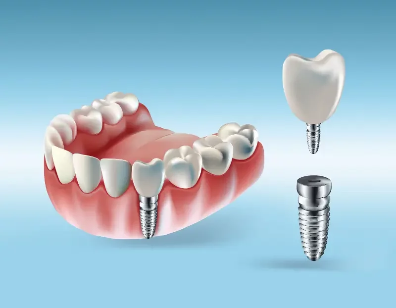 Implantat-Leistungsbild-v2